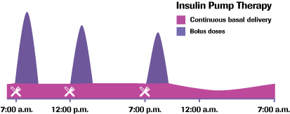 insulin pump therapy